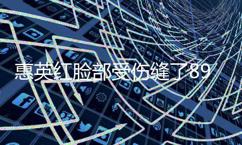 惠英紅臉部受傷縫了89針，經(jīng)歷令人震驚
